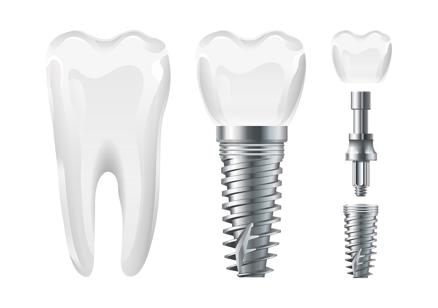 Dental Implants vs Dentures: Which Should I Choose?