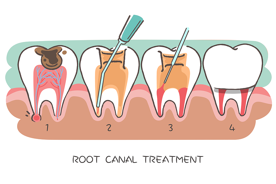 Restore Your Dental Health with Root Canal Therapy: A Comprehensive Guide