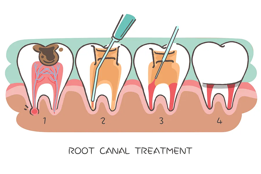 Restore Your Dental Health with Root Canal Therapy: A Comprehensive Guide