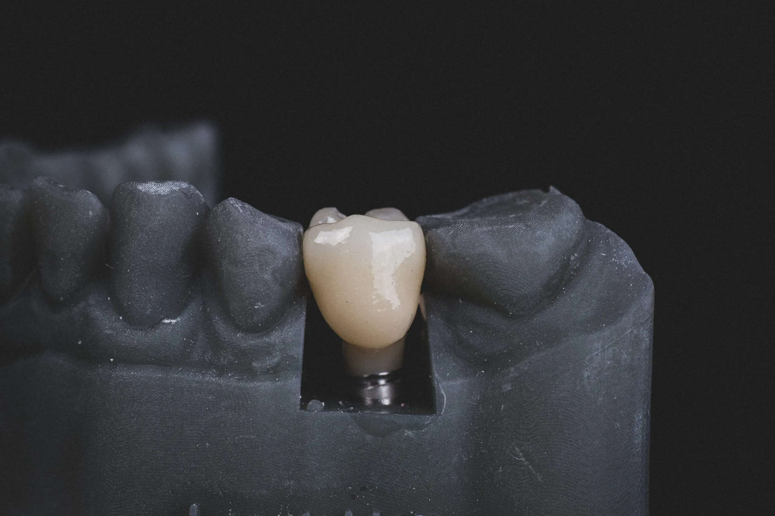 Why Dental Implants are the Best Long-Term Solution for Missing Teeth in Tomball, TX